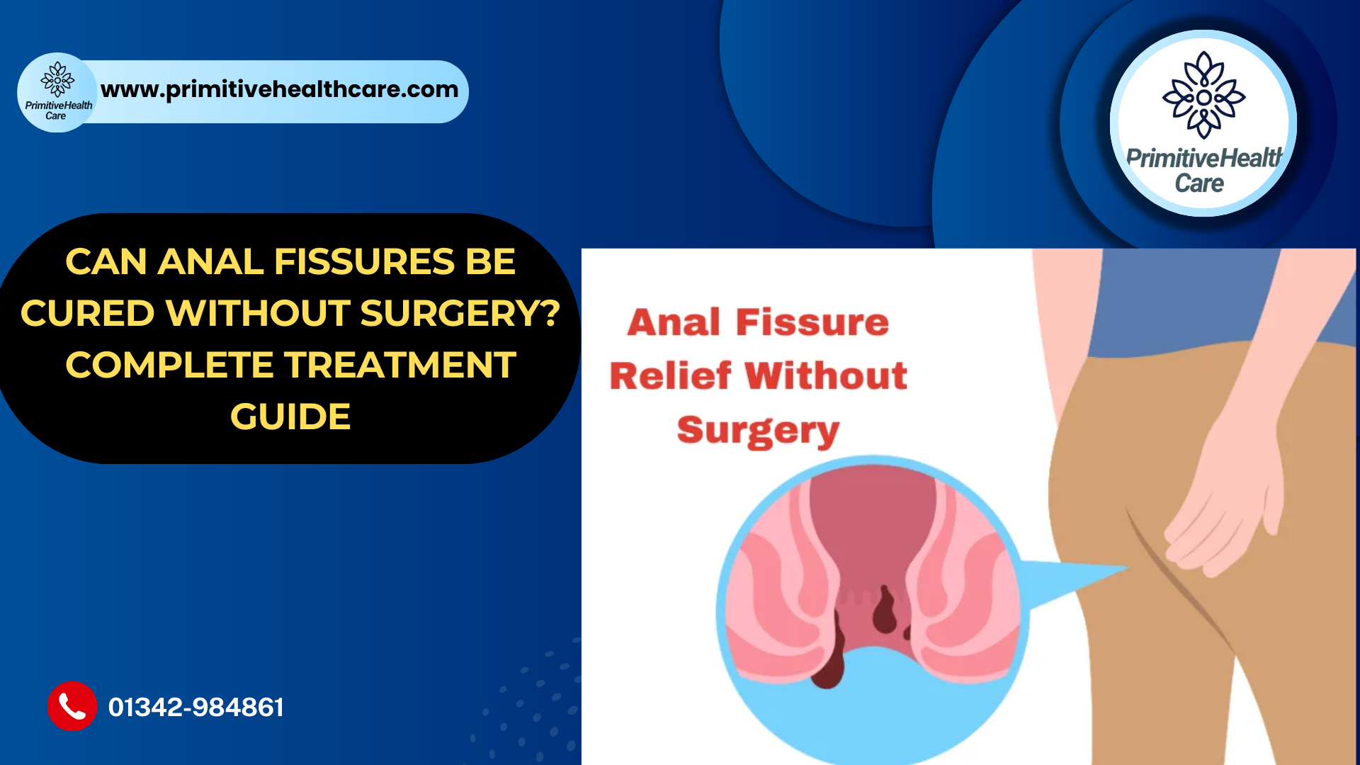 Can Anal Fissures Be Cured Without Surgery?